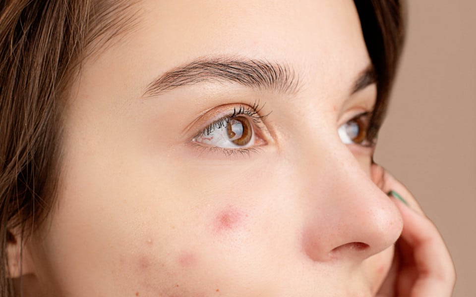 acne i about acne 230223094529 (1)