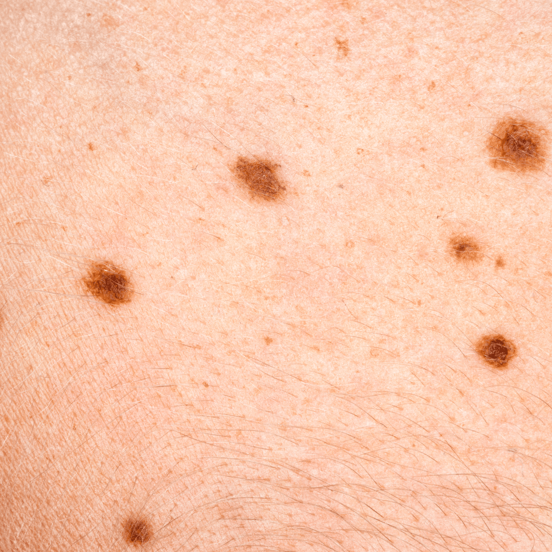 Moles and skinspots
